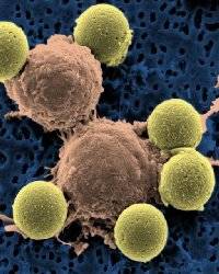 Modified killer T-cells wipe out leukemia: US study
